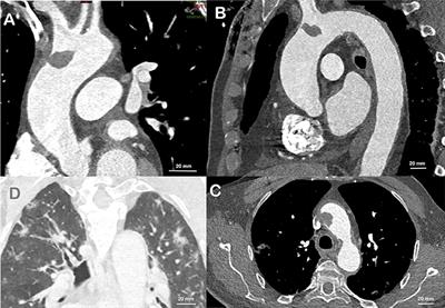 Thrombus of the Aorta and SARS-CoV-2 Infection: Cause or Trigger?